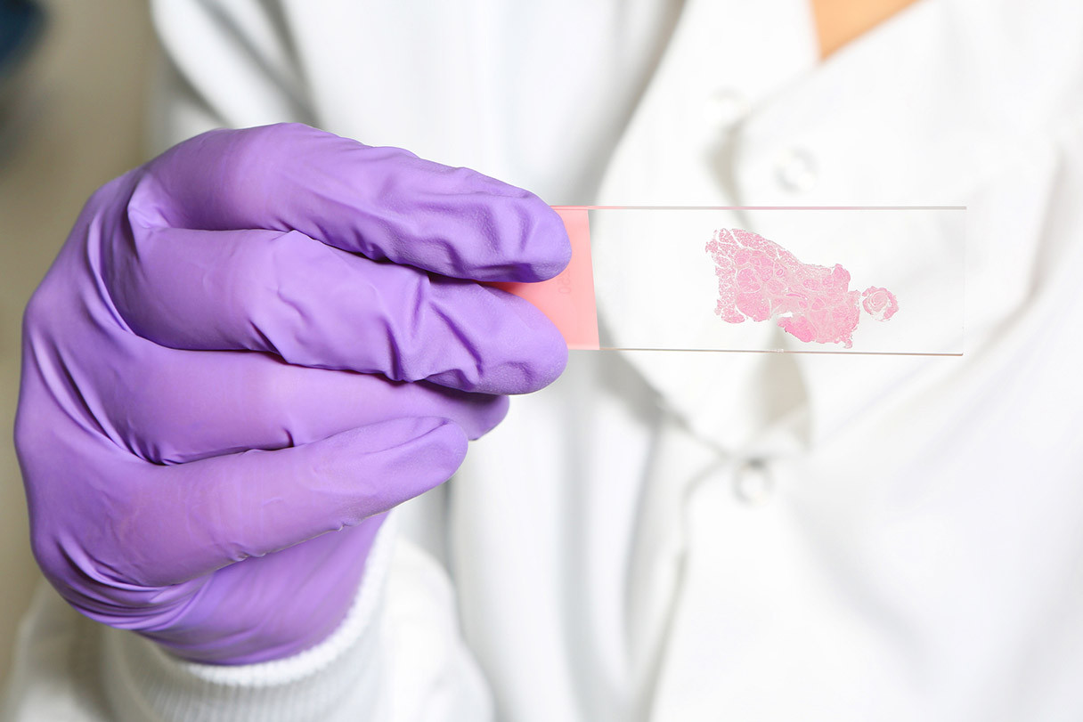 Path2Space: AI revoluționează diagnosticul cancerului - predicție genetică rapidă și accesibilă