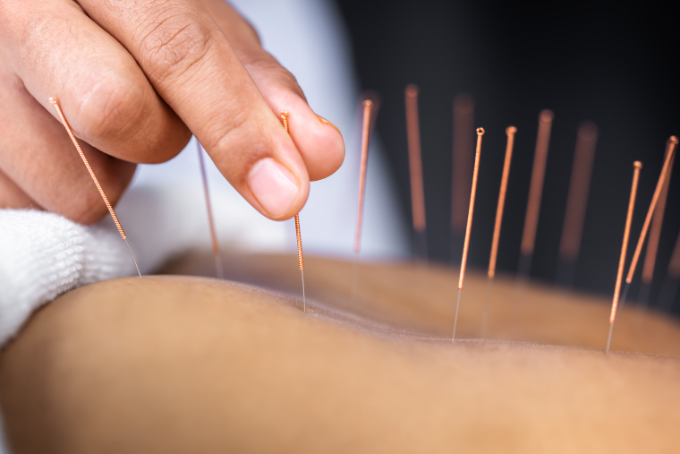 Știința desface misterul acupuncturii: cum un ac declanșează sistemul natural de calmare a durerii din corp